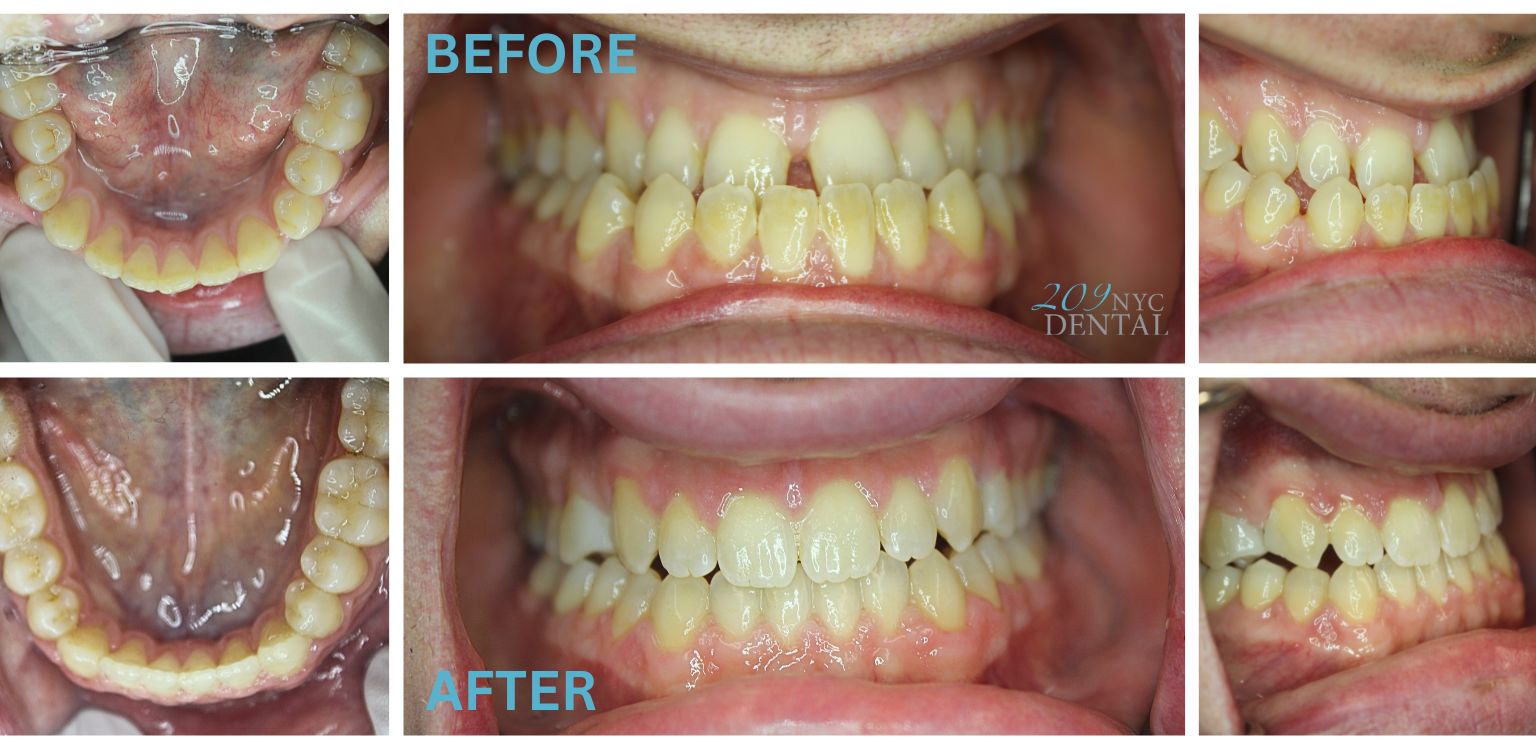 Invisalign for Underbite Before and After results achieved at 209 NYC Dental
