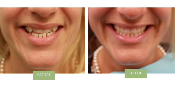 A before-and-after image of someone who received Invisalign for underbite in NYC