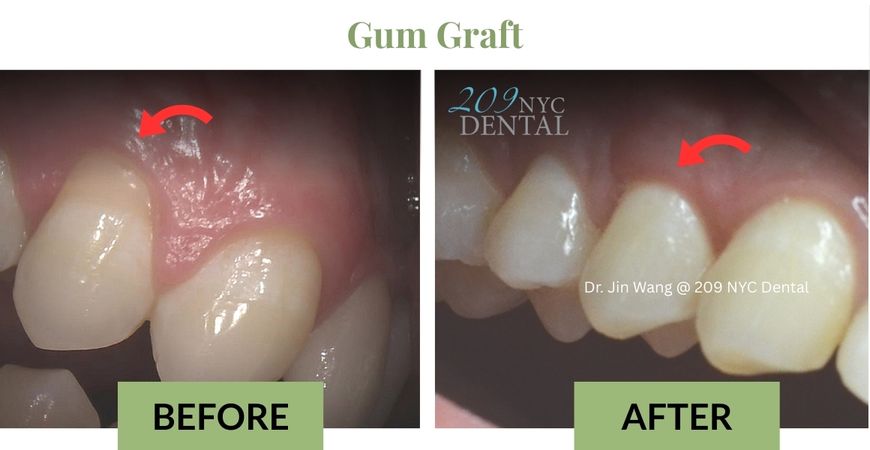 Gum Graft for receding gum by Dr. Jin Wang @ 209 NYC Dental