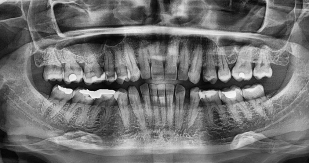 Panoramic dental x-ray showing a mouth with several missing teeth