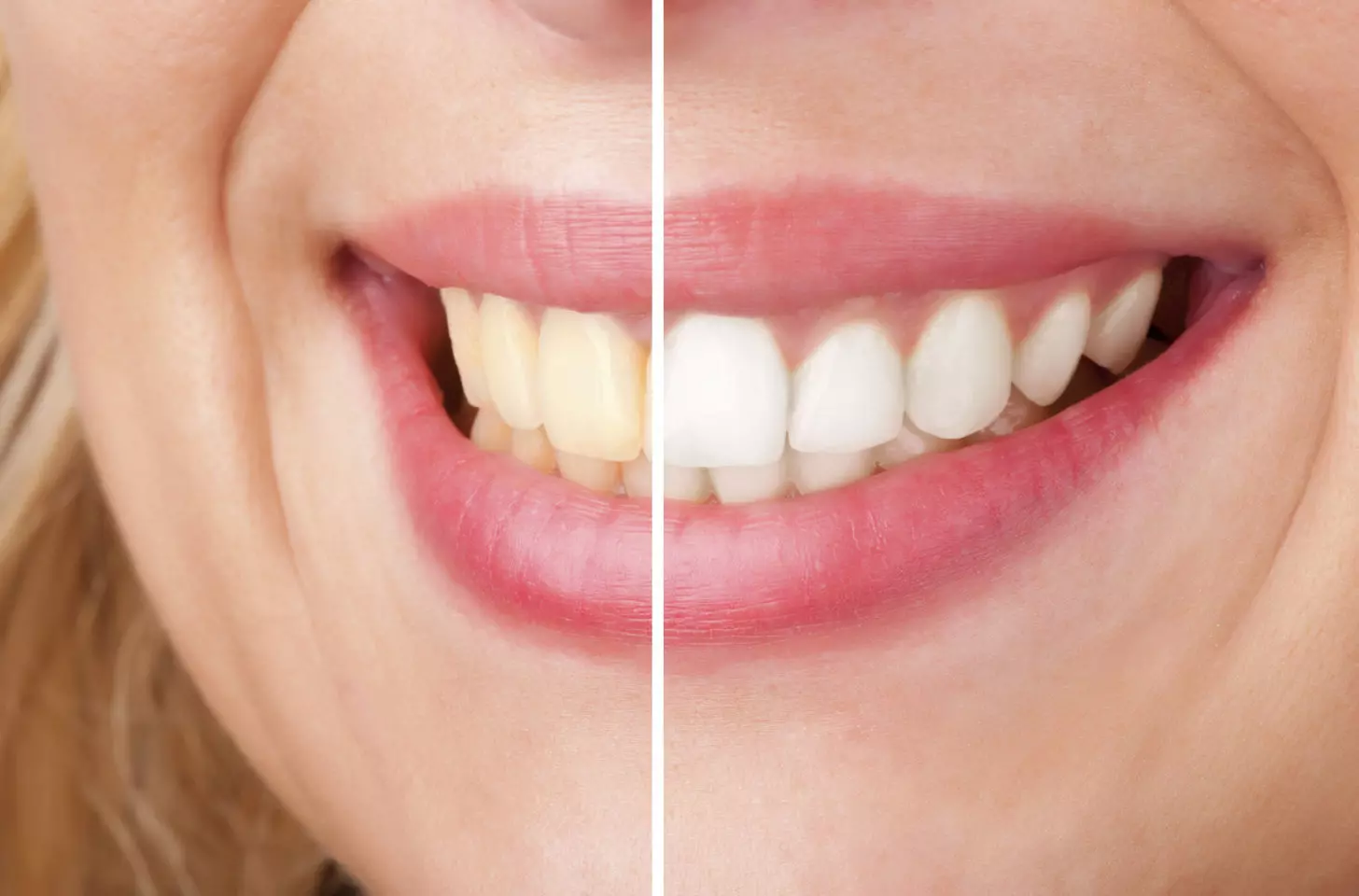 A before-and-after image of teeth whitening results illustrating the debate over whether whitening strips damage enamel.
