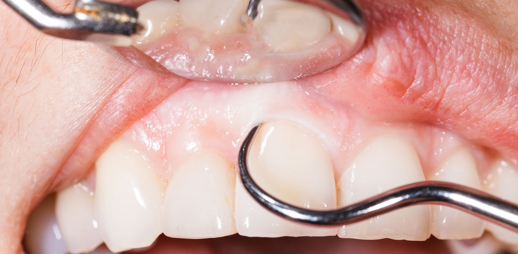 A close-up image of a dentist checking a tooth before performing a dental crown lengthening
