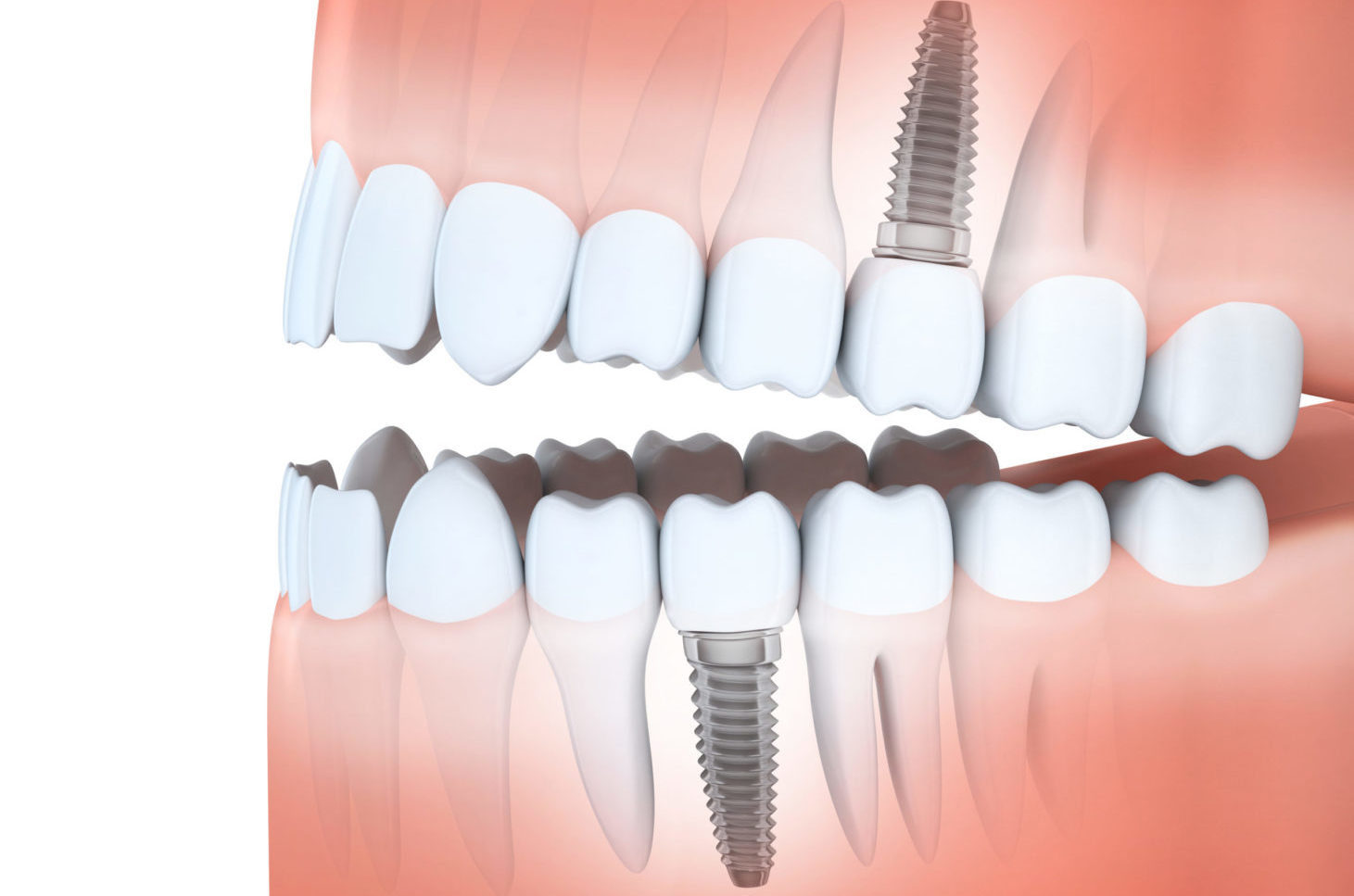 Human jaw and dental implants replacing missing teeth