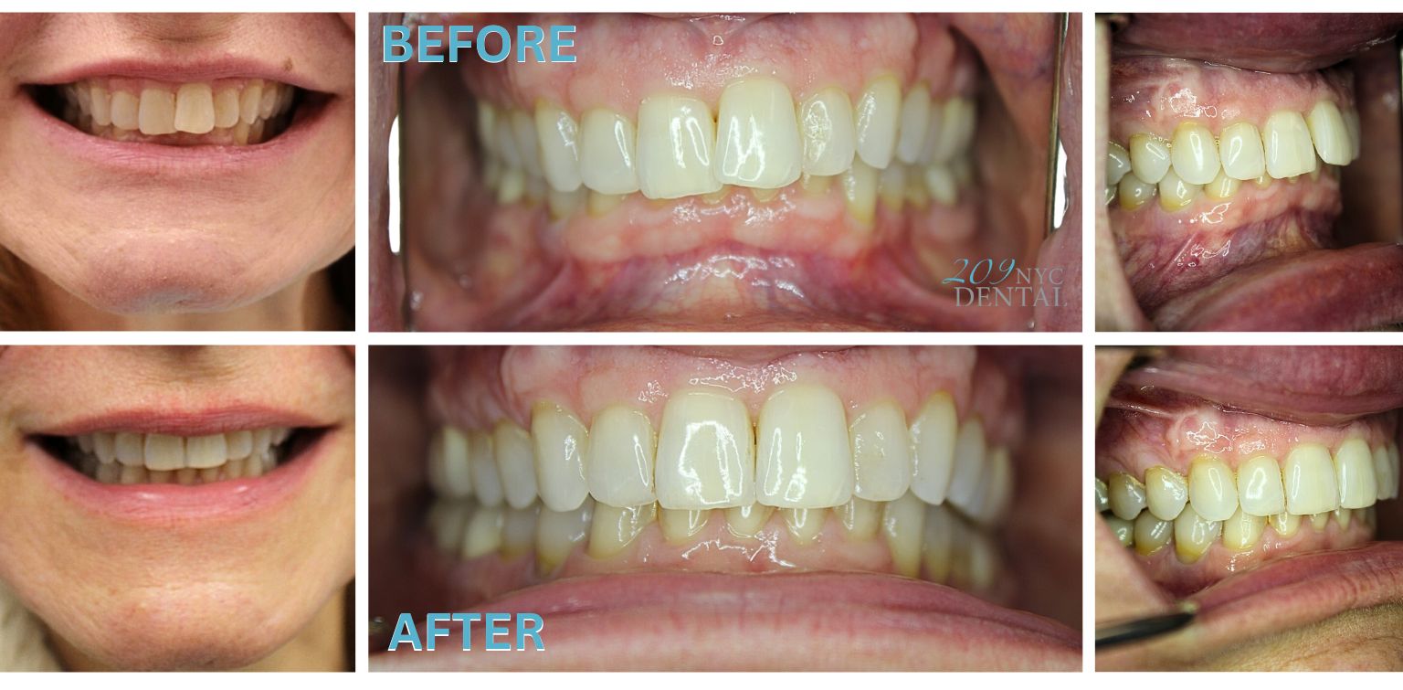 Invisalign for Overbite Before and After results achieved at 209 NYC Dental