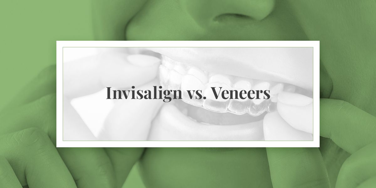 Invisalign vs. Veneers  Everything You Need to Know