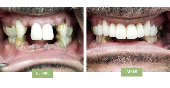 A before-and-after image of porcelain crowns and bridges in NYC