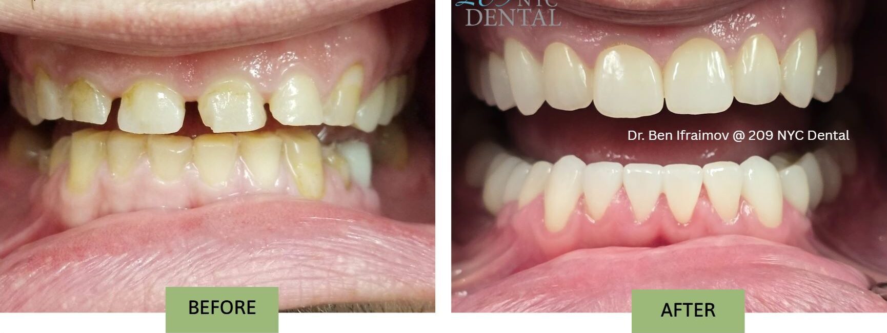 Patient smile transformation before and after treatment