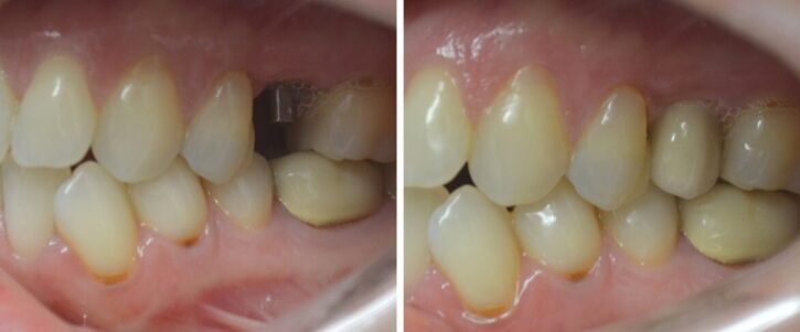 Before and after side-by-side comparison of a single tooth dental implant placement restoring a missing tooth