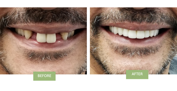 Full mouth reconstruction with Dental Implants & Implant Bridge in NYC