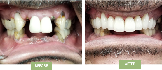 Complete smile makeover of the upper jaw. Dr. Jin Wang replaced two missing teeth with implants. Dr. Ben Ifraimov restored upper arch using implant and traditional crowns
