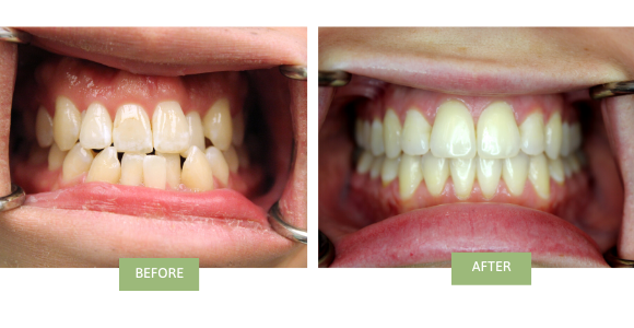 A before-and-after image of a smile restoration
