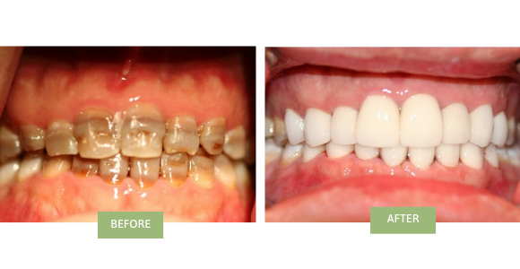 A before-and-after image showing a teeth makeover from a patient’s teeth that had medication stains