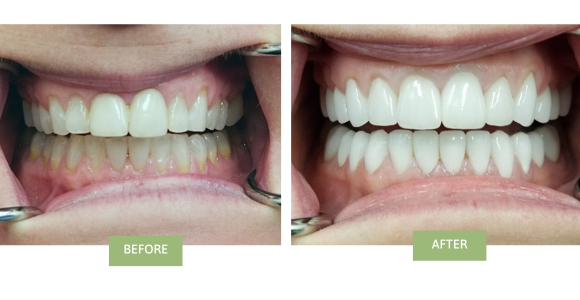 Dental veneers before and after photos