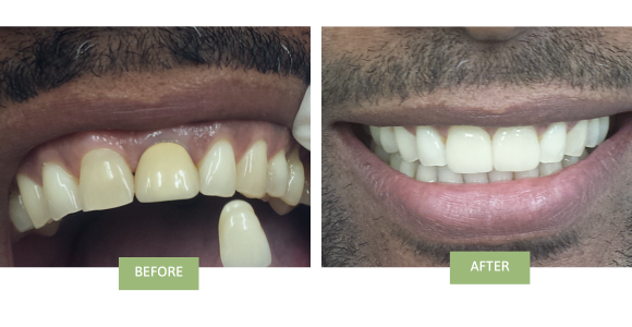 Porcelain veneers and ceramic crowns near me before and after photos