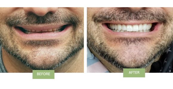 Dental veneers before and after photos