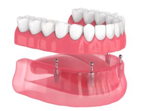 ball retained all on four dental implants near me