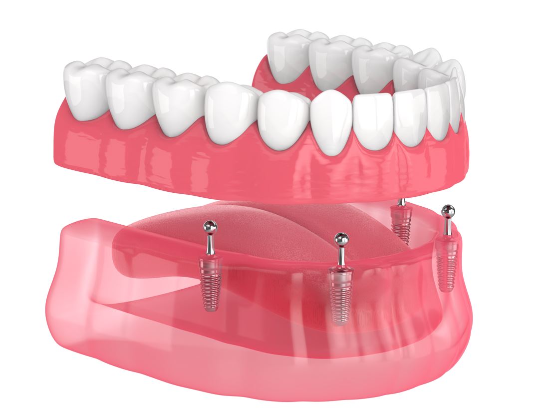 ball retained all on four dental implants near me
