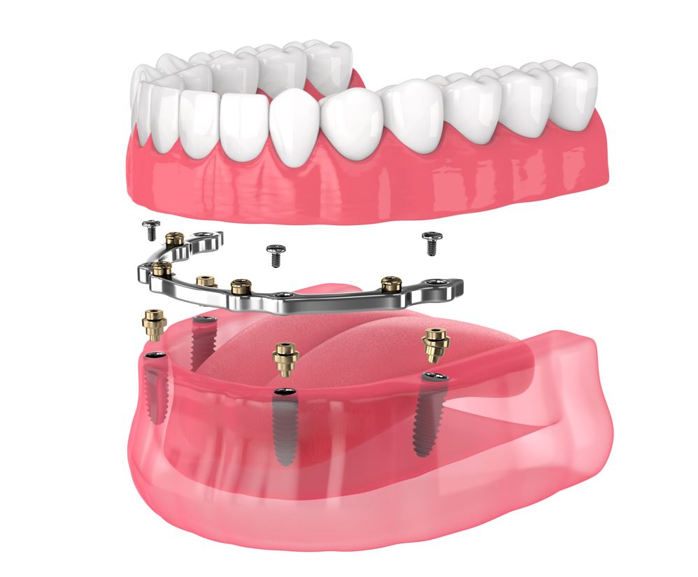 bar retained implant denture nyc