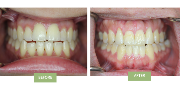 An image of before and after Invisalign for open bite