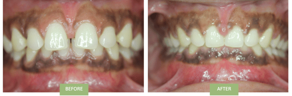 Invisalign for Gaps NYC - Before and after