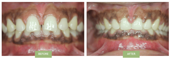 Invisalign for Gaps NYC - Before and after