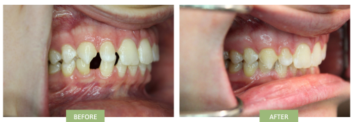 huge spaces between front teeth in both upper jaw & lower jaw were successfully closed with Invisalign