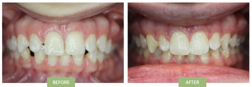Gaps between teeth closed with clear Clear braces 