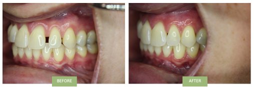 Invisalign for gaps before and after - side view showing huge diastema between upper front teeth before Invisalign treatment and no diastema after Invisalign.