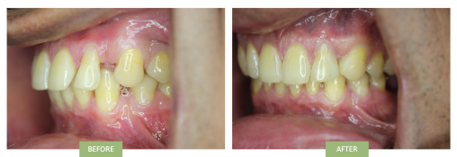 Invisalign for gaps before and after - side view showing huge gaps between upper incisors and canines before Invisalign treatment ^ no gaps after Invisalign.