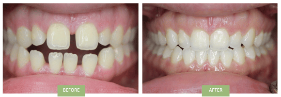 Invisalign for open bite in NYC