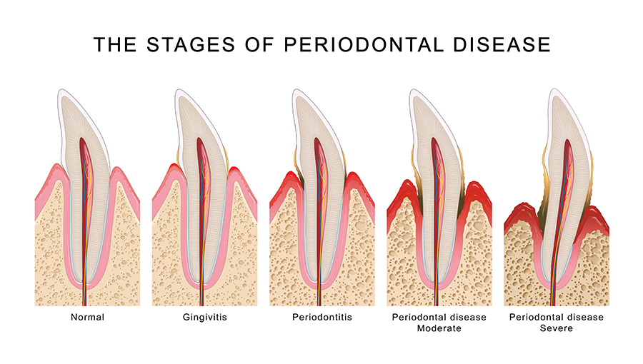 Stage of periodontal disease illustration
