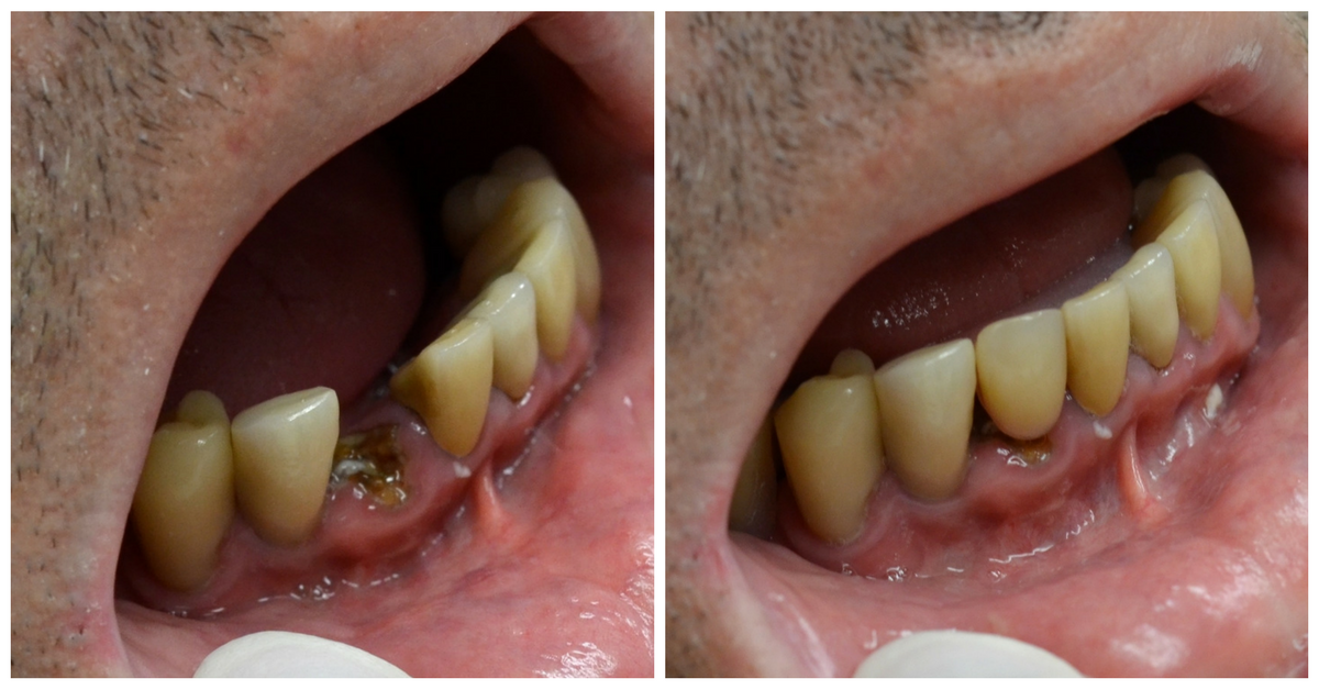temporary tooth after extraction and dental implant placement surgery