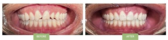 Broken Front Teeth: before and after - dental emergency near me
