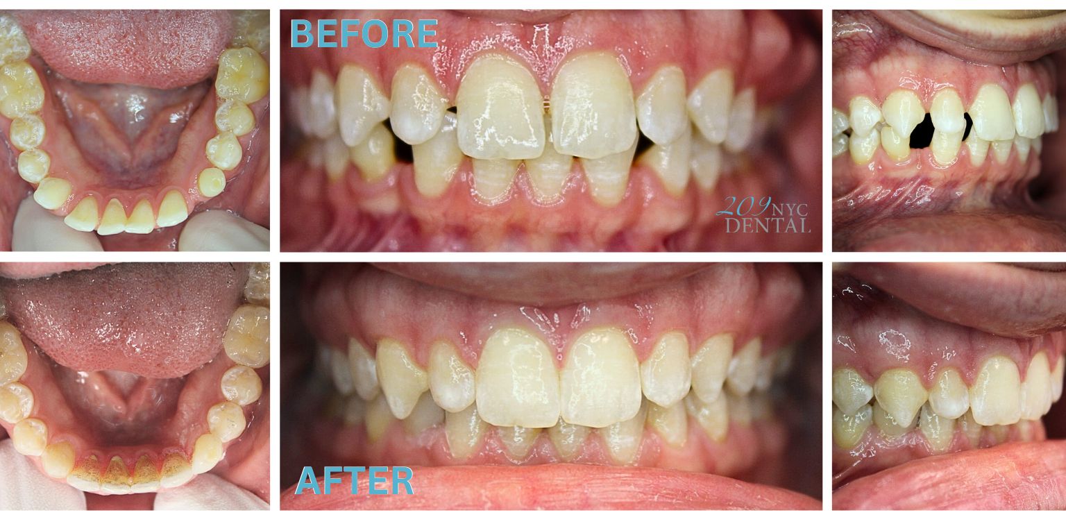 Invisalign for gaps Before and After results achieved at 209 NYC Dental