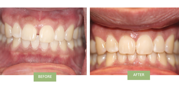 A before-and-after image of Invisalign gap teeth treatment