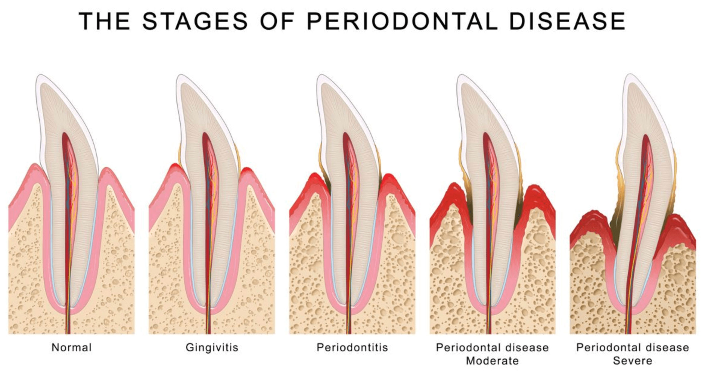 A graphic showing gum disease stages