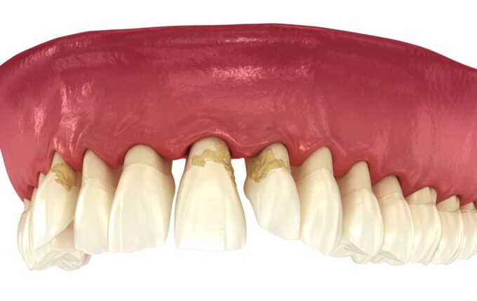 A 3D rendering of gum recession