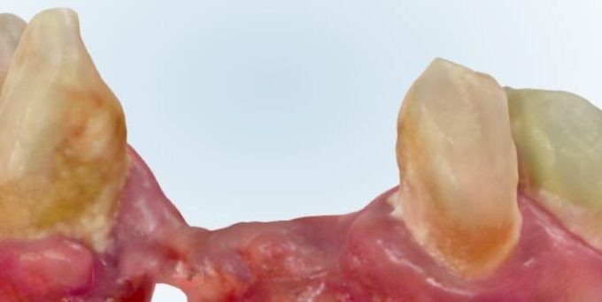 A gum disease picture that shows periodontal disease