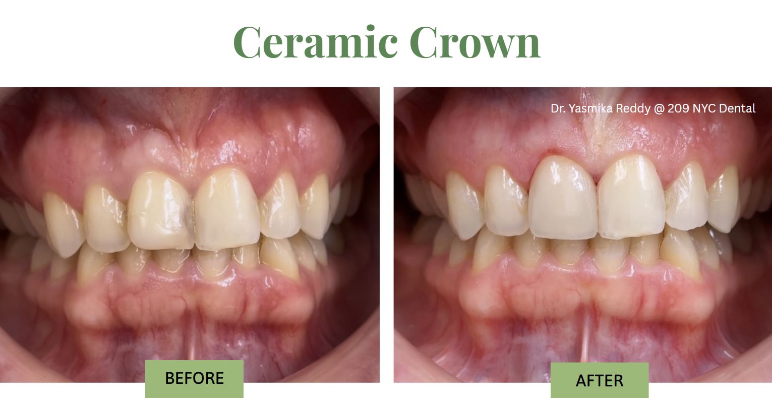 ceramic crown before and after done by Dr. Yasmika Reddy in 209 NYC Dental