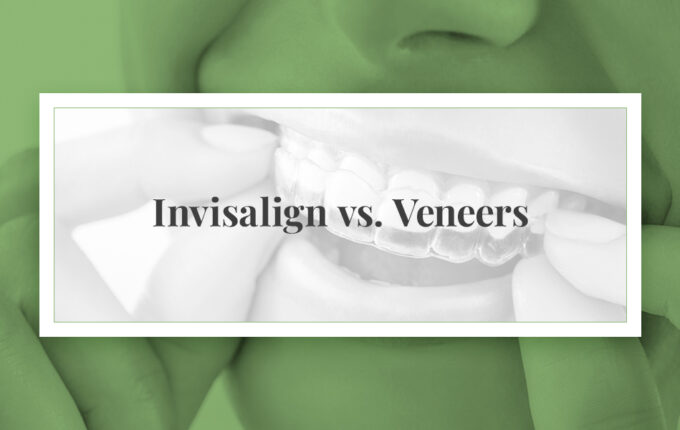 A person placing an Invisalign aligner in their mouth