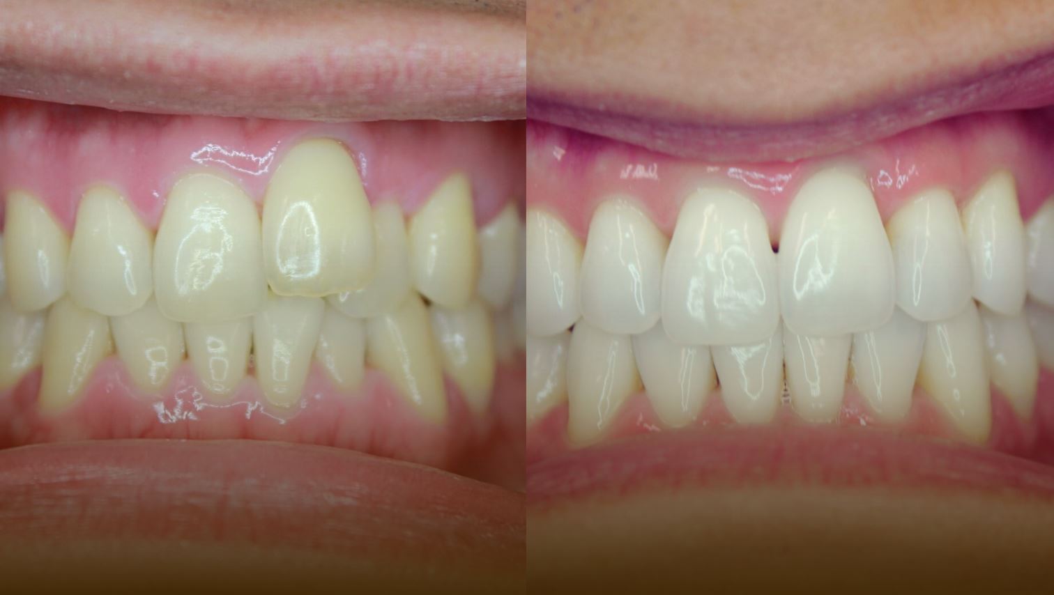 alternatives to veneers: teeth whitening + invisalign