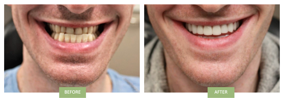 Invisalign & Veneers for Underbite before and after photos