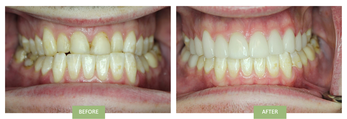 Invisalign & Veneers for Underbite before and after photos (3)