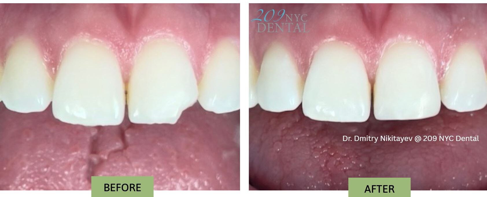 Before & after - Broken filling repair - same day - Dr. Nikitayev - 209 NYC Dental - dental bonding: Patient presented with a complaint that an old filling on the front tooth broke. Dr. Nikitayev evaluated and restored tooth with a new beautiful dental bonding using color matching dental composite material.