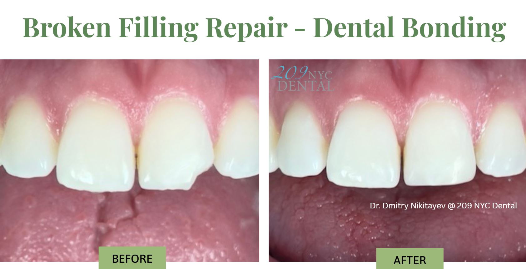 Before & after - Broken filling repair - same day - Dr. Nikitayev - 209 NYC Dental - dental bonding: Patient presented with a complaint that an old filling on the front tooth broke. Dr. Nikitayev evaluated and restored tooth with a new beautiful dental bonding using color matching dental composite material.