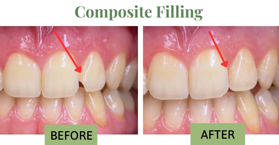 Same day Composite filling - 209 NYC Dental - Dr. Yasmika Reddy