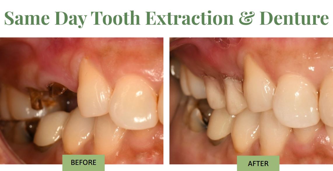 Dental emergency tooth extraction and same day denture