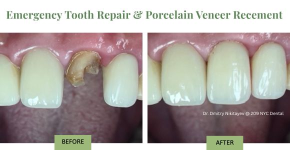 An emergency patient traveling from abroad urgently needed help after her veneer/crown popped off. Dr. Nikitayev saw her the same day (Saturday), cleaned the tooth, expertly re-cemented the veneer, and restored her smile—same day!