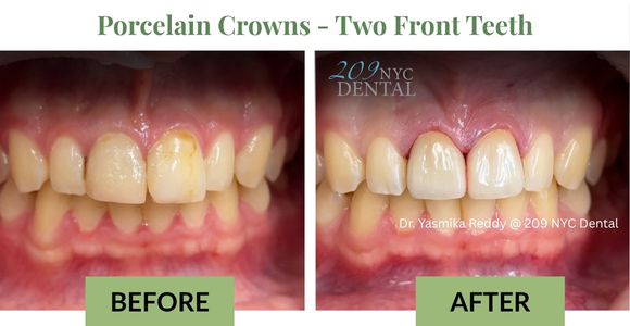 Porcelain Crowns - Two Front Teeth - Before & After by DR. Yasmika Reddy at 209 NYC Dental