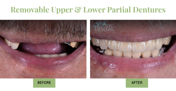 Patient smiling in before and after photos for removable Upper & Lower Partial Dentures